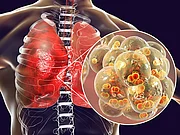 Pneumococcal pneumonia, medical concept