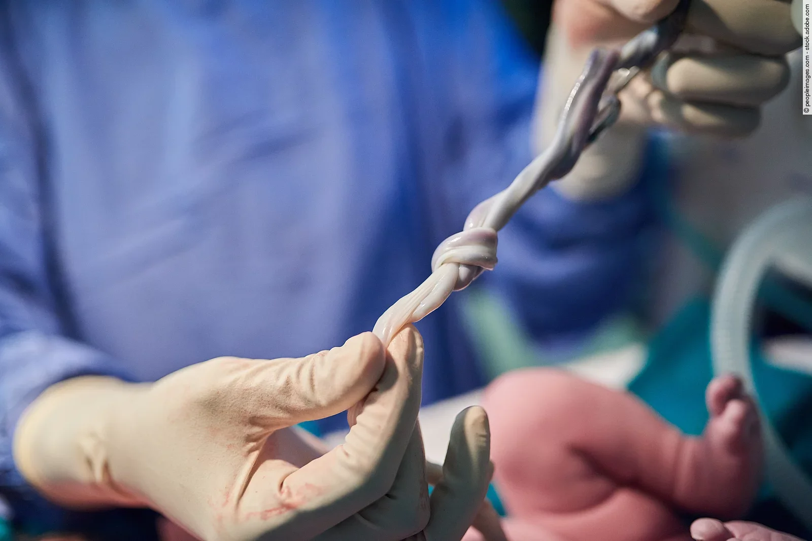 Neugeborenes mit Nabelschnur