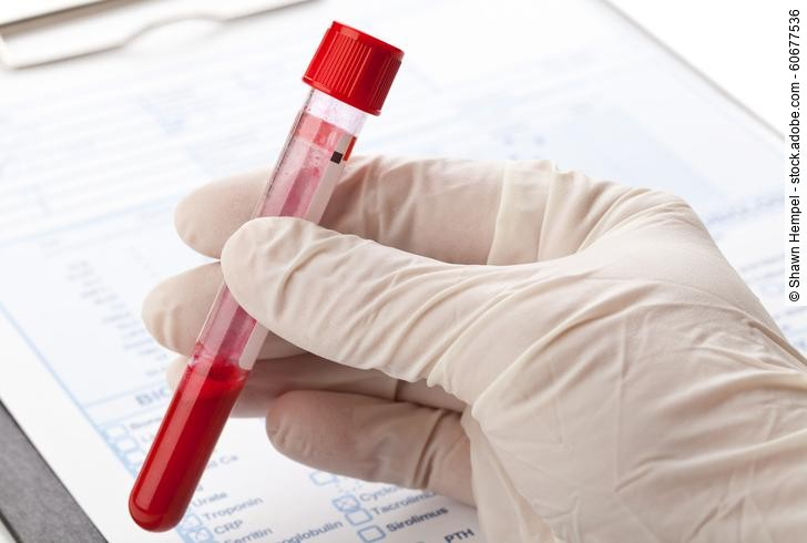 Hand with latex glove holding blood sample vial in front of blood test form